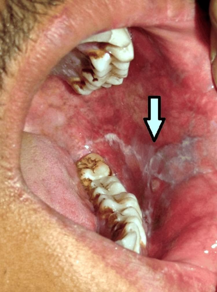 This clinical photograph shows an intraoral view of the left buccal mucosa, illustrating characteristic signs of oral lichen planus. The primary finding is the presence of reticular white striae, also known as Wickham striae, which form a distinct lacy or net-like pattern across the mucosal surface. These lesions are situated adjacent to the mandibular molar region. The surrounding background mucosa exhibits significant erythema, suggesting an inflammatory component consistent with the erosive or erythematous subtype of the condition. A white arrow points toward the concentrated area of reticular striae. The image serves as a classic diagnostic reference for medical and dental students to identify oral mucosal auto-inflammatory diseases. Key educational concepts include recognizing non-scrappable white patches, distinguishing reticular patterns from other leukoplakic lesions, and understanding the clinical presentation of lichen planus within the oral cavity.