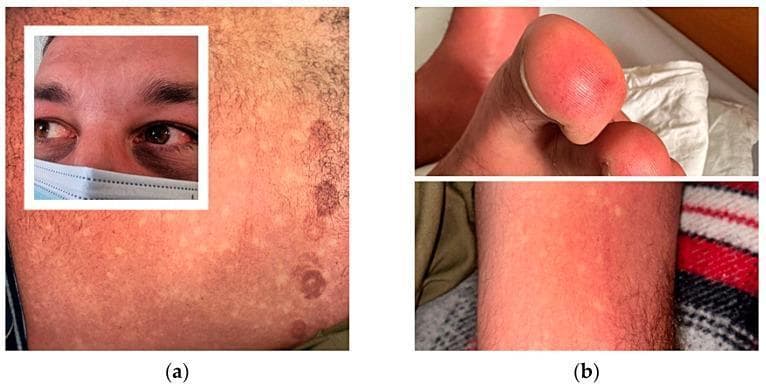 This composite of clinical photographs illustrates the classic dermatological and ocular manifestations of Dengue fever. Panel (a) displays a characteristic confluent erythematous, blanching maculopapular rash on the chest, often described as 'islands of white in a sea of red' due to distinct patches of skin sparing. Additionally, circular ecchymotic lesions are visible on the lateral chest wall, corresponding to pressure sites from ECG electrodes. An inset focuses on the patient's face, showing bilateral subconjunctival hemorrhages and periorbital ecchymoses. Panel (b) illustrates peripheral vascular involvement, showing cutaneous vasculitis of the fingers and toes, characterized by intense erythema and swelling. The lower panel in (b) further demonstrates the diffuse erythematous rash on the lower limb with smaller focal spots of skin sparing. These findings are hallmarks of Dengue Hemorrhagic Fever (DHF) and emphasize the systemic vascular permeability and coagulopathy associated with the virus.