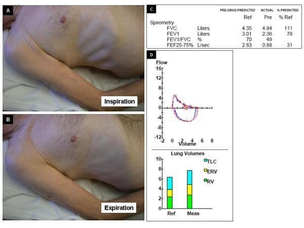 A multi-panel clinical graphic illustrating the physical and diagnostic findings of Hoover's sign in a patient with airway obstruction. Panels A and B contain clinical photographs of a male patient's torso in a lateral recumbent position. Panel A (Inspiration) demonstrates a paradoxical inward retraction of the lower rib cage and intercostal spaces, a classic physical sign of diaphragmatic flattening often seen in severe COPD or emphysema. Panel B (Expiration) shows the relative expansion or outward movement of the same region. Panel C provides a spirometry data table showing an obstructive pattern: a reduced FEV1/FVC ratio (49%) and low FEF25-75% (31% of predicted). Panel D includes a flow-volume loop demonstrating characteristic expiratory flow limitation and a bar chart of lung volumes. The lung volume chart highlights significant hyperinflation and gas trapping, characterized by an elevated Residual Volume (RV) and Total Lung Capacity (TLC) compared to reference values. This composite image serves to correlate physical examination findings of abnormal chest wall dynamics with quantitative pulmonary function testing in obstructive lung disease.