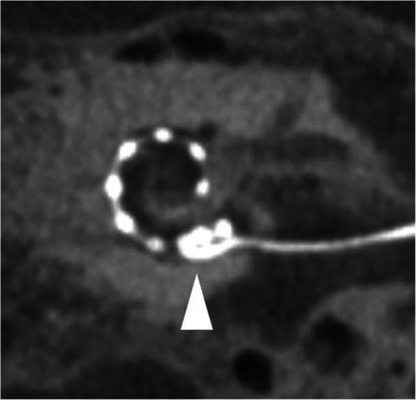 This diagnostic image is a Cone-Beam Computed Tomography (CBCT) paraaxial maximum intensity projection (MIP) focusing on the inner ear anatomy. It demonstrates a cochlear implant electrode array positioned within the cochlea. The electrode is visualized as a spiral series of hyperdense (bright), discrete contacts that follow the cochlear turns. A white arrowhead indicates a specific surgical complication: a basal fold-over. In this malposition, the proximal (basal) portion of the electrode array has bent or doubled back on itself within the basal turn of the cochlea, rather than following a smooth spiral insertion. This image is used in otolaryngology and radiology to evaluate post-operative cochlear implant placement and to identify mechanical insertion complications that can impact auditory outcomes. The CBCT modality provides high spatial resolution with reduced metal artifact compared to standard HRCT, allowing for detailed visualization of individual electrode contacts relative to the bony cochlear walls.