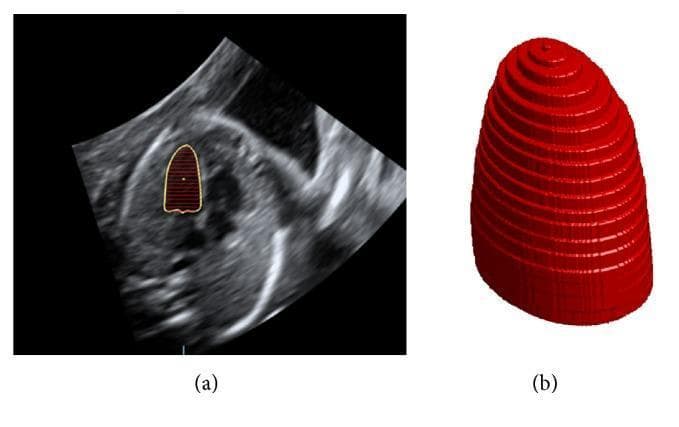 This medical figure illustrates the application of the Single Plane Simpson's method (disk summation) for calculating left ventricular (LV) volume from ultrasound imaging. Image (a) is a 2D echocardiographic ultrasound frame in a grayscale sectoral view. The left ventricle is highlighted by a yellow solid contour tracing the endocardial border. Within this contour, a series of parallel red horizontal lines represent the individual axes used to divide the LV cavity into discrete cylindrical disks. Image (b) presents a corresponding 3D volumetric model rendered in solid red. This model visualizes the LV as a stack of short cylinders, creating a truncated conical shape that tapers from the base toward the apex. The horizontal segments in the 3D model demonstrate the additive geometry used to estimate total volume. This visualization is used in cardiology and obstetrics for assessing cardiac function parameters such as stroke volume (SV) and ejection fraction (EF) by modeling the complex geometry of the heart more accurately than simpler elliptical assumptions.
