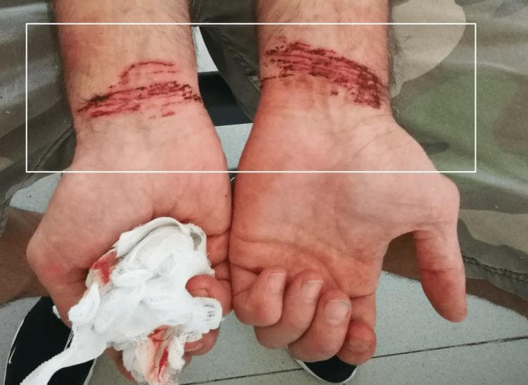 This clinical photograph displays the bilateral palmar wrists of a patient, showing multiple self-inflicted injuries. The lesions are characterized as parallel, linear abrasions and superficial incised wounds. These injuries exhibit varying depths, with evidence of fresh blood and minor oozing. The wounds are concentrated in a horizontal orientation across the wrist crease, with a higher density and severity noted on the left wrist compared to the right. In the foreground, the patient's left hand is holding a blood-stained white gauze pad. The image serves as a forensic and psychiatric educational tool for identifying patterns of non-suicidal self-injury (NSSI) or manipulative self-harm. The visual presentation of parallel, uniform, and accessible-site injuries is highly characteristic of intentional self-infliction rather than accidental trauma. The clinical context involves forensic examination to differentiate between genuine suicidal intent and secondary gain motivation.