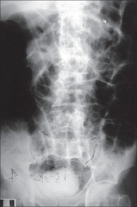 A plain abdominal X-ray (radiography) in an anteroposterior projection demonstrating signs of intestinal obstruction. The image reveals multiple centrally located, dilated loops of bowel characterized by radiolucent (dark) air-filled segments. These distended loops are arranged in a 'ladder-like' pattern with visible valvulae conniventes extending across the full width of the lumen, which is characteristic of a small bowel obstruction. The periphery of the abdomen shows generalized gas distension, though some regions on the left are obscured by radiopaque densities. In the lower pelvic region, linear and fragmented radiopaque foreign materials are visible, possibly surgical clips or markers. The lumbar spine and pelvic bones provide anatomical context, while punctate radiopaque densities scattered in the abdominal field may suggest dystrophic calcifications. This diagnostic image is intended for medical education on the radiological features of mechanical bowel obstruction and the use of abdominal flat plates in acute clinical settings.