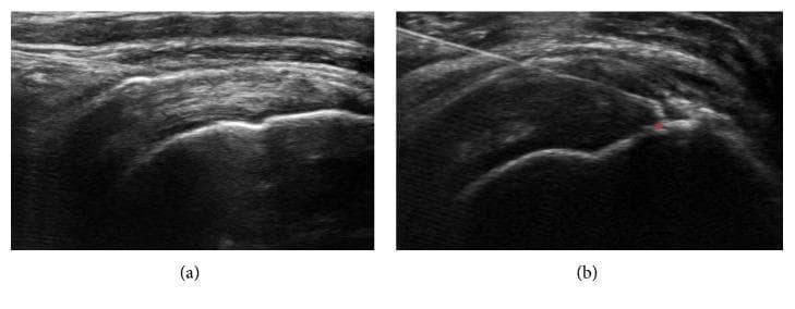Two side-by-side musculoskeletal ultrasound images (long-axis view) demonstrating an ultrasound-guided injection for rotator cuff pathology. Image (a) shows the baseline anatomy of the shoulder, including the hyperechoic humeral head, the overlying supraspinatus tendon, and the subacromial-subdeltoid bursa. Image (b) illustrates a dynamic clinical procedure where a thin, hyperechoic, linear needle is seen entering from a lateral approach. The needle tip is precisely positioned at a focal hypoechoic defect within the supraspinatus tendon, which is marked with an asterisk to signify a partial-thickness tear. This diagnostic image highlights the use of real-time ultrasound for precise needle placement during regenerative medicine or corticosteroid injections in orthopedic clinical practice. Key features include the visualization of tendon architecture, cortical bone contours, and the characteristic reverberation artifact of the metal needle.