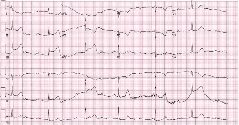 A standard 12-lead electrocardiogram (ECG) with rhythm strips (V1, II, V5) showing an acute inferior ST-elevation myocardial infarction (STEMI) complicated by high-grade atrioventricular (AV) block. Significant ST-segment elevation is present in the inferior leads (II, III, and aVF), with the magnitude of elevation in lead III exceeding that in lead II, suggesting a right coronary artery (RCA) occlusion. Reciprocal ST-segment depression and T-wave inversion are visible in the high lateral leads (I, aVL) and anterior lead V2. The rhythm analysis reveals complete heart block (third-degree AV block) characterized by atrioventricular dissociation, with an atrial rate significantly faster than the ventricular escape rate (approximately 37 bpm). The QRS complexes are wide, and P waves do not maintain a fixed relationship with the ventricular activity. This visual findings are pathognomonic for an inferior wall MI with ischemia to the AV node, commonly associated with a proximal RCA lesion.