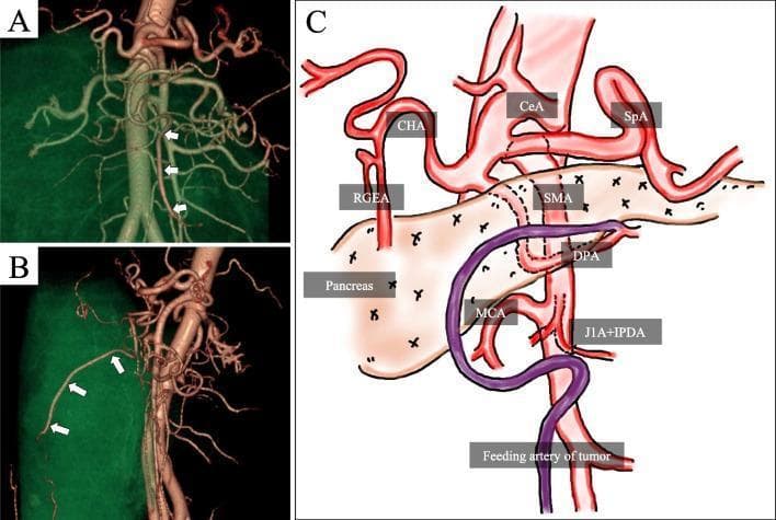 This composite image illustrates the vascular anatomy related to a retroperitoneal tumor feeding artery using 3D-CT angiography and a schematic diagram. Panels A (coronal) and B (sagittal) display 3D reconstructions of the abdominal aorta and its major branches. White arrows in both panels track a specific vessel, identified as a branch of the dorsal pancreatic artery (DPA), which serves as the primary feeding artery for a large abdominal tumor. Panel C provides a labeled schematic of this region, detailing the anatomical relationships between the celiac artery (CeA), splenic artery (SpA), common hepatic artery (CHA), and superior mesenteric artery (SMA). The DPA is shown originating from the SMA and giving rise to the tumor's feeding artery (highlighted in purple). Other visualized structures include the right gastroepiploic artery (RGEA), middle colic artery (MCA), first jejunal artery (J1A), and inferior pancreaticoduodenal artery (IPDA). This visual material is intended for advanced medical education in surgical oncology and radiology, emphasizing the use of 3D angiography for preoperative identification of tumor origins and vascular supply in complex retroperitoneal masses.