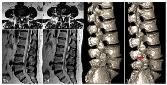 This composite diagnostic image illustrates a clinical case of lumbar disc herniation at the L4-L5 level in a female patient, showcasing pre-operative and post-operative status through multiple imaging modalities. The pre-operative axial and sagittal T2-weighted MRI scans (a, b) demonstrate a right paracentral disc herniation causing significant compression of the L5 nerve root and thecal sac. The 12-month post-operative MRI scans (c, d) show complete resolution of the herniated nucleus pulposus and restoration of the spinal canal space, effectively relieving neural compression. Panels (e) and (f) provide three-dimensional CT reconstructions of the lumbar spine, offering a lateral view of the vertebral architecture. The post-operative reconstruction (f) features a red arrow indicating the enlargement of the L4-L5 intervertebral foramen, a direct result of surgical foraminoplasty. These images collectively provide a comprehensive comparison of disc morphology, canal patency, and foraminal decompression, serving as an educational resource for spinal surgery outcomes and radiological assessment of degenerative disc disease.