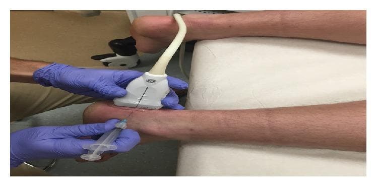 This clinical photograph demonstrates a sonographically guided injection procedure for chronic insertional Achilles calcific tendinosis. The patient is positioned prone with the lower leg and ankle resting on a padded examination table. A clinician wearing purple sterile gloves is shown performing a real-time ultrasound-guided intervention. One hand stabilizes a linear ultrasound probe placed in a short-axis orientation over the posterior calcaneal region to visualize the Achilles tendon insertion and associated enthesophytes. The other hand directs a 25-gauge needle attached to a syringe containing a lidocaine and dextrose mixture (prolotherapy). The needle is inserted at a shallow, medial-to-lateral trajectory, targeting the area anterior to the calcaneal enthesophyte. This procedural image illustrates the technique of ultrasound-guided fenestration and injection, emphasizing the coordinate placement of the imaging transducer and the needle to ensure precise delivery of the injectate into the pathology-affected tissues. The clinical focus is on musculoskeletal medicine, specifically the management of tendinopathy through minimally invasive regenerative techniques.