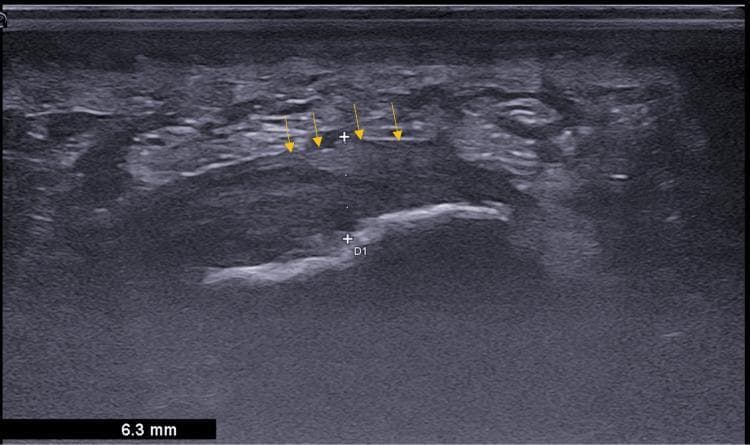 This diagnostic image is a sagittal B-mode ultrasound of the plantar heel in a 38-year-old female patient, demonstrating sonographic features characteristic of plantar fasciitis. The primary focus is the plantar fascia, which appears as a significantly thickened, hypoechoic band-like structure indicated by yellow arrows in the mid-upper region. Calipers (marked 'D1') measure the fascial thickness at 6.3 mm, which is pathological compared to normal physiological limits. There is a notable loss of the normal organized fibrillar pattern within the fascial body. Deep to the plantar fascia, the hyperechoic cortical surface of the calcaneus is visible, characterized by a bright, dense acoustic reflection. This image serves as a clinical example of musculoskeletal imaging for diagnosing chronic heel pain, highlighting key diagnostic criteria: thickening >4 mm, reduced echogenicity, and loss of internal architectural detail.