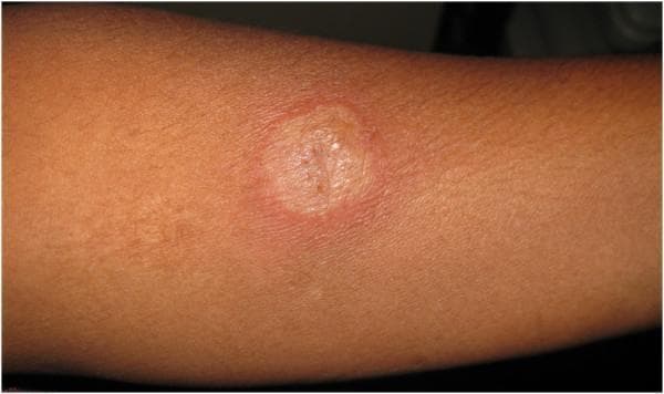 This clinical photograph displays a positive Mantoux tuberculin skin test on the volar aspect of a patient's forearm. The visual hallmark is a central, well-demarcated area of induration, appearing as a raised, firm, and palpable plaque. The indurated center exhibits a slightly lighter, yellowish-tan coloration with a textured, peau d'orange appearance compared to the surrounding skin. Encircling this central induration is a broad, poorly defined halo of erythema (redness). The reaction site is roughly circular, and a small central puncture mark from the intradermal injection is visible. In the clinical context provided, this measure of 28 mm represents a strongly positive reaction, indicating a delayed-type hypersensitivity response to Purified Protein Derivative (PPD). Such a robust reaction is highly suggestive of infection with Mycobacterium tuberculosis and, in this specific case, correlates with systemic findings of ocular and pulmonary tuberculosis.