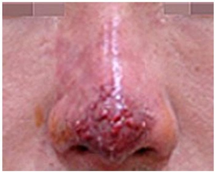 This clinical photograph shows a close-up view of the human nose exhibiting signs of vascular compromise and secondary infection following a dermatological procedure. The primary pathology is localized to the nasal tip and dorsum, where a cluster of small, raised, erythematous pustules is prominently visible. These lesions are characterized by a rounded morphology and a deep red to violaceous hue, suggesting intense underlying inflammation and possible infection. The skin of the nasal bridge appears edematous and displays a shiny texture with diffuse erythema extending towards the glabella. In contrast, the skin on the adjacent cheeks maintains a more normal tone and texture, highlighting the localized nature of the inflammatory process. The visual findings are consistent with an infection state and impending tissue necrosis, likely resulting from vascular occlusion post-filler injection. This image serves as a clinical reference for identifying early progression from ischemic stages to pustule formation and potential eschar development in aesthetic medicine complications.