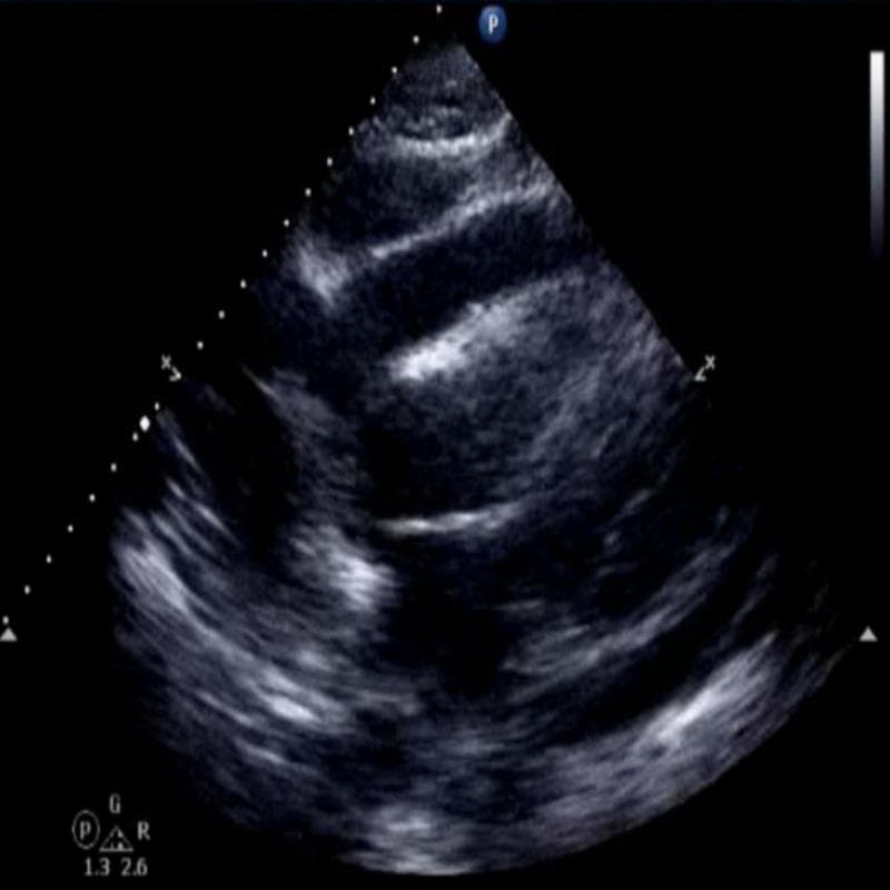 Diagnostic Image: This subcostal view echocardiogram demonstrates a moderate to large circumferential pericardial effusion. The effusion is identified as a prominent anechoic (dark), echo-free space located between the hyper-echogenic pericardium and the epicardial surface of the heart. The fluid collection surrounds the cardiac chambers, most notably the left ventricle, creating a clear separation between the heart and the surrounding pleural and diaphragmatic interfaces. The cardiac silhouette appears centralized within the fluid collection, and the significant depth of the anechoic space suggests a substantial volume of fluid accumulation. This finding is clinically significant for evaluating pericardial tamponade physiology in patients presenting with shortness of breath, low voltage on EKG, or pulsus paradoxus. Key educational concepts include ultrasound identification of fluid in the pericardial sac, subcostal windows in emergency medicine or cardiology, and the distinction between pericardial and pleural fluid collections.