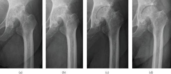 A series of four sequential plain anteroposterior radiographs of a single hip joint, demonstrating the progression of degenerative hip osteoarthritis over a three-year interval. Image (a) represents the baseline, showing terminal-stage osteoarthritis characterized by severe joint space narrowing, subchondral sclerosis, and multiple large bone cysts in the femoral head and acetabulum, resulting in poor joint congruity. Image (b) at one year shows static radiographic findings despite clinical conservative management. Images (c) and (d), corresponding to years two and three, illustrate progressive joint remodeling. Key findings include a visible widening of the radiographic joint space, improved congruity between the femoral head and the acetabular roof, and a reduction in the size and density of the subchondral bone cysts. The final image (d) shows a smoother femoral head contour and more uniform bone density compared to baseline. This series highlights the longitudinal morphological changes possible in advanced osteoarthritis through non-surgical interventions, specifically focusing on joint space recovery and cortical remodeling.