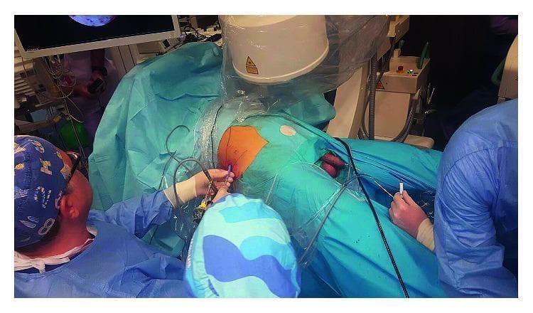 Clinical photograph of a urological surgical procedure, likely Percutaneous Nephrolithotomy (PCNL), demonstrating a modified supine-oblique (Valdivia-Galdakao) patient positioning. The patient is draped in a sterile blue field with the right flank exposed and prepared for percutaneous access. A C-arm fluoroscopy unit is positioned over the patient's torso for intraoperative imaging, with a monitor in the background displaying real-time visual data. The surgical team is arranged to allow simultaneous access: one surgeon operates at the flank, performing a renal puncture or nephroscopy, while an assistant is positioned between the patient's abducted and secured legs to perform retrograde endourological maneuvers (e.g., ureteroscopy or catheter placement). The patient's legs are secured independently in a slightly abducted, non-flexed position to facilitate this dual access to the upper and lower urinary tract. This configuration optimizes workflow for endoscopic combined intrarenal surgery (ECIRS) by providing wide flank exposure and retrograde access to the bladder.