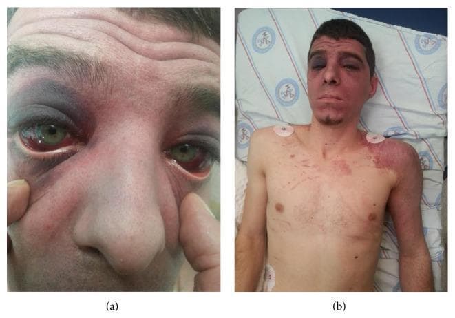 Two-panel clinical photograph of a trauma patient demonstrating signs consistent with traumatic asphyxia. Panel (a) shows a close-up of the periorbital region featuring bilateral subconjunctival hemorrhages, characterized by bright red blood beneath the bulbar conjunctiva. Pronounced periorbital ecchymosis ('raccoon eyes') and eyelid edema are visible, particularly affecting the right orbit. Panel (b) provides a wider view of the patient's torso and face, illustrating facial cyanosis and significant petechial eruptions across the anterior chest wall and left upper extremity. The lesions are small, non-blanching, reddish-purple macules. Larger areas of confluent ecchymosis are noted on the left shoulder and upper arm. ECG electrodes are visible on the chest, indicating clinical monitoring. These visual findings typically result from severe compressive thoracic trauma leading to retrograde venous hypertension in the superior vena cava distribution. Target audience: medical students and emergency medicine trainees.