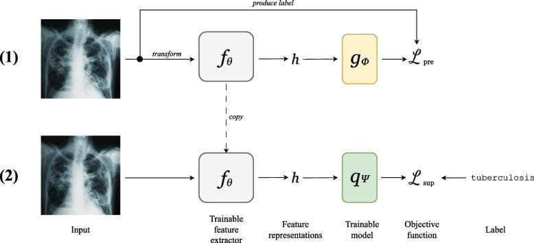 A two-stage machine learning flowchart illustrating a Self-Supervised Learning (SSL) workflow applied to chest X-ray classification. The diagram is divided into two phases: (1) Self-supervised pretraining and (2) Supervised fine-tuning. In the first phase, a chest X-ray exhibiting bilateral reticular opacities and areas of consolidation is used as input. It undergoes a transformation and is processed by a trainable feature extractor (f-theta) to produce feature representations (h), which are then sent to a trainable model (g-phi) to minimize a pretext objective function. In the second phase, the learned feature extractor parameters are copied to a new model. A similar chest X-ray input is processed to produce representations (h) for a different trainable model (q-psi). This stage incorporates specific diagnostic labels, such as 'tuberculosis', to minimize a supervised objective function (L-sup). The diagram highlights the educational concept of using unlabelled medical imaging data to learn useful anatomical and pathological features before applying them to specific clinical diagnostic tasks.