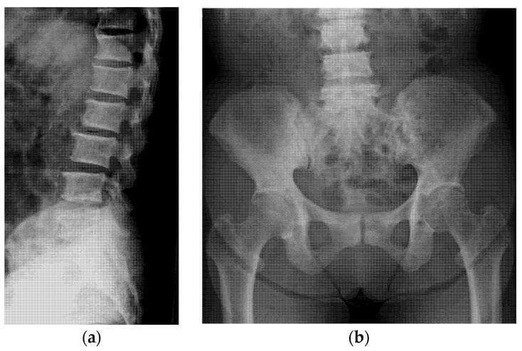 Two-panel plain film radiograph of the axial skeleton illustrating diffuse osteoblastic activity. Image (a) is a lateral projection of the thoracolumbar spine showing generalized, marked increase in radiodensity (sclerosis) within the vertebral bodies, resulting in a 'chalky' or 'ivory' appearance of the vertebrae. The intervertebral disc spaces appear relatively preserved. Image (b) is an anteroposterior (AP) view of the pelvis and lumbar spine, demonstrating widespread sclerotic changes throughout the sacrum and bilateral iliac bones. Notably, the proximal femurs maintain normal cortical and medullary radiodensity, highlighting the axial distribution of the pathology. These radiographic findings are characteristic of osteoblastic metastases, commonly seen in secondary malignancies such as prostate or gastric cancer. The educational focus is on the recognition of diffuse bone sclerosis as a manifestation of systemic disease and the clinical utility of plain radiographs in identifying metastatic bone lesions.