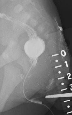 This lateral pelvic x-ray (radiography) demonstrates a contrast-enhanced fistulogram in a neonate with an anorectal malformation (imperforate anus). The diagnostic image highlights a distended, contrast-filled distal rectal pouch positioned superior to the expected level of the anal opening. A long, narrow, radiopaque fistulous tract is visible, originating from the perineal skin surface (vestibular region) and ascending superiorly to communicate with the rectal pouch. A radiopaque ruler is placed externally along the posterior-inferior margin to measure the distance between the skin surface and the terminal end of the rectum, a critical measurement for classifying the malformation as high, intermediate, or low. The vertebral bodies and sacrum are visible, providing anatomical landmarks for evaluating the height of the rectal pouch relative to the pelvic floor. This study is essential for surgical planning, specifically for determining the approach for a posterior sagittal anorectoplasty (PSARP).