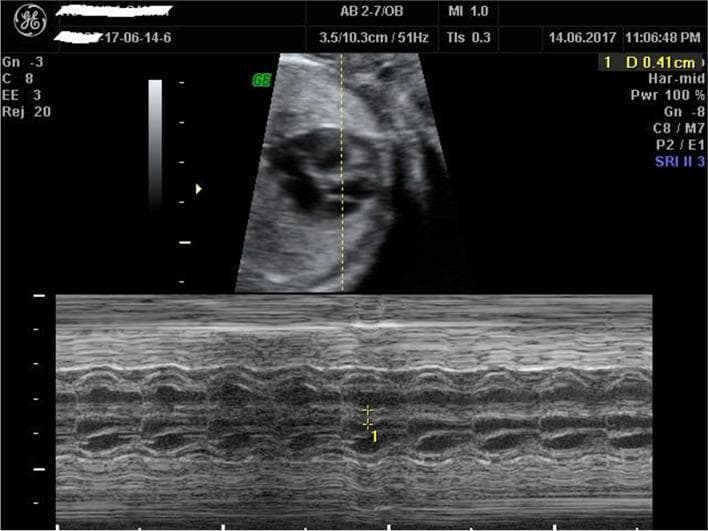 Fetal M-mode echocardiography used for the quantitative assessment of the heart. The image is split into two sections: the top displays a 2D B-mode ultrasound of the fetal thorax in a transverse four-chamber view. A vertical, dotted M-mode cursor is positioned perpendicularly across the interventricular septum (IVS), just distal to the atrioventricular valves. The bottom section displays the corresponding M-mode tracing, showing the motion of the cardiac structures over time. The IVS is visualized as a rhythmic, undulating hyperechoic structure. Calipers (labeled '1') are placed on the M-mode tracing to measure the interventricular septal thickness at end-diastole, recorded as 0.41 cm in the top-right metadata. This diagnostic technique is used to screen for fetal myocardial hypertrophy, which is defined as septal thickness exceeding two standard deviations for gestational age. The image demonstrates cardiac wall motion and structural thickness throughout the cardiac cycle, providing essential data for prenatal cardiovascular evaluation.