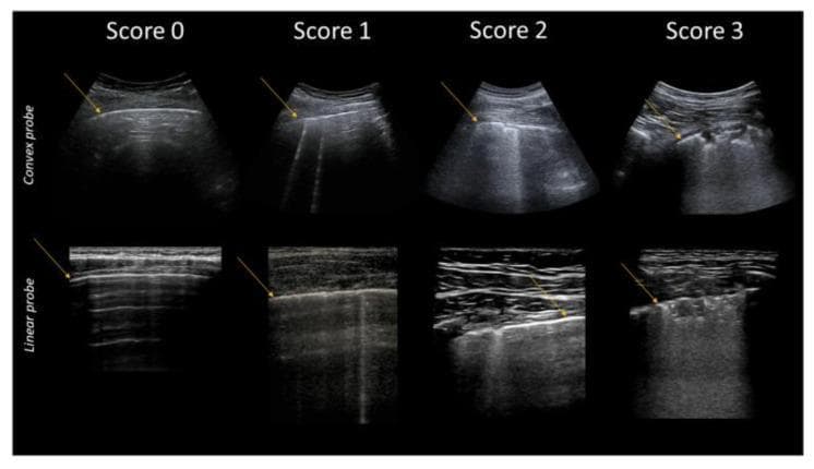 This diagnostic comparison chart illustrates the lung ultrasound (LUS) grading system for COVID-19 pathology using convex (top row) and linear (bottom row) probes. The images classify findings into four severity scores: Score 0 represents a normal lung with a smooth, continuous pleural line (indicated by arrows) and horizontal A-lines. Score 1 shows initial interstitial involvement, characterized by the appearance of isolated vertical B-lines originating from the pleural line. Score 2 demonstrates worsening interstitial syndrome, showing confluent B-lines or 'white lung' patterns, where multiple vertical artifacts coalesce. Score 3 indicates severe pathology, visible as pleural line fragmentation and subpleural consolidations—cuneiform hypoechoic areas often containing hyperechoic spots (air bronchograms). The linear probe images provide higher resolution of the pleural interface, while the convex probe images show a wider field of view for deeper artifact assessment. This visual guide is intended for clinical triage and monitoring of pulmonary involvement in viral pneumonia.