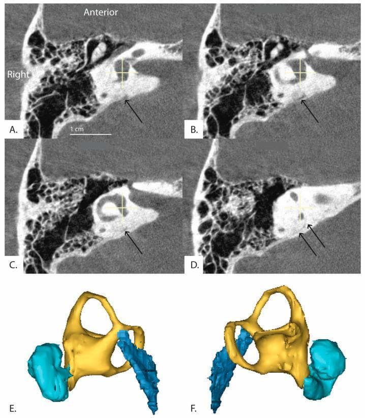 This composite educational resource features high-resolution imaging of the human inner ear anatomy. Panels A-D display sequential axial CT images reformatted in the plane of the horizontal semicircular canal, progressing from an inferior to superior perspective. Black arrows highlight the distal vestibular aqueduct as it traverses the petrous temporal bone. The images demonstrate the spatial relationship between the bony labyrinth, including the vestibule and semicircular canals, and the vestibular aqueduct. Panels E and F provide 3D anatomical reconstructions (right and left views, respectively) illustrating the complex spatial morphology of these structures. The color-coding in the 3D models differentiates key components: the cochlea is shown in cyan, the vestibule and semicircular canals in yellow, and the vestibular aqueduct in dark blue. This visualization is intended to assist in the clinical assessment of inner ear pathologies, such as Meniere's disease or superior canal dehiscence syndrome, by mapping the trajectory and angle of the vestibular aqueduct relative to the labyrinthine structures.