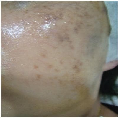 This clinical photograph displays the facial skin of a patient with melasma, specifically focusing on the lateral cheek and temple area. The image reveals numerous hyperpigmented macules and patches of varying sizes and shapes. These pigmented lesions range in color from light tan to dark brown, demonstrating a patchy, heterogeneous distribution typical of dermal or mixed melasma. The skin surface appears smooth and hydrated with a visible reflective sheen, and there are no signs of scaling, erythema, or post-inflammatory hyperpigmentation (PIH). The visual evidence represents a follow-up state after multiple treatment modalities, including Q-switched 1064 nm Nd:YAG laser sessions and adjuvant vitamin C therapy. The educational focus is on identifying clinical patterns of facial hyperpigmentation and evaluating treatment response in dermatologic practice for disorders of pigmentation.