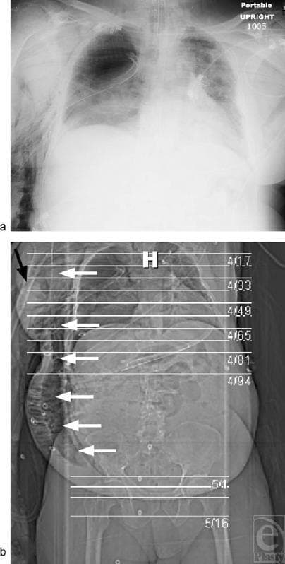 This diagnostic imaging composite displays a case of severe, extensive subcutaneous emphysema. Panel (a) is a portable anteroposterior chest roentgenogram showing radiolucent (dark) air streaks dissecting through the soft tissues of the chest wall and neck, disrupting normal tissue planes. A right-sided chest tube is visible, and the chest wall appears significantly thickened due to air entrapment. Panel (b) is a computed tomography (CT) scout film/topogram of the torso. White arrows highlight the craniocaudal distribution of subcutaneous air extending from the thoracic region down into the abdominal and pelvic subcutaneous tissues. A black arrow indicates a prepectoral 'blowhole' incision on the right chest wall, designed for air decompression. The image illustrates the radiographic manifestations of barotrauma or persistent air leak under positive pressure ventilation, characterized by the 'ginkgo leaf sign' on the chest wall and diffuse mottled low-density areas throughout the trunk's soft tissues.