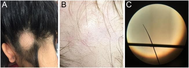 This composite educational image illustrates the clinical and microscopic features of alopecia areata (AA). Image A is a clinical photograph of a patient's posterior scalp, showing a single, well-demarcated, smooth patch of non-scarring hair loss located near the lower occiput and nape of the neck (ophiasis-like distribution). Image B provides a high-magnification view of the affected scalp, highlighting pathognomonic 'exclamation point hairs'—short, broken hairs that are narrower at the base near the scalp than at the distal end. Image C is a light microscopy frame of a hair shaft obtained via a pull test, demonstrating a classic tapered hair bulb characteristic of rapidly progressive AA. These visual findings are essential for distinguishing non-scarring autoimmune alopecia from other pediatric conditions like tinea capitis or trichotillomania. The educational focus is on identifying clinical morphology, trichoscopic markers, and microscopic hair shaft anomalies used in dermatologic diagnosis.
