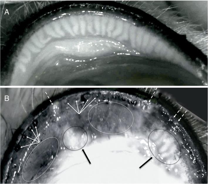 This diagnostic image displays non-contact infrared meibography of the upper eyelid, comparing a healthy state (A) with Meibomian Gland Dysfunction (MGD) (B). Image A demonstrates a normal anatomical distribution of meibomian glands, appearing as regular, vertical, hyperreflective linear structures. Image B illustrates several pathological features of MGD: diffused ductal occlusion and plugging of the gland orifices (indicated by dotted white arrows) and posterior migration of the mucocutaneous junction with retroplacement of ductal openings (indicated by multiple thin white arrows). Morphological changes within the glands are highlighted, including cystic dilatation of the ducts containing dense, opaque secretions (black arrows and black ovals). These areas alternate with regions of significant hyporeflectivity (white ovals), representing acinar atrophy and gland dropout. This comparison serves as a clinical educational tool for identifying terminal duct obstruction and glandular degeneration during ocular surface evaluations.