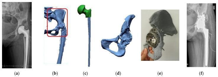A multi-panel figure illustrating the computer-aided design (CAD) and 3D-printing workflow for complex revision hip arthroplasty. (a) Pre-operative X-ray of the hip showing a temporary antibiotic-loaded cement spacer (SPACER) in situ following primary implant removal. (b) 3D volumetric reconstruction of the pelvis and proximal femur derived from CT data, with a red bounding box indicating the region of interest for surgical planning. (c) Digital segmentation and isolation of the hip endoprosthesis components, including the femoral stem and head. (d) A refined 3D digital model of the hemi-pelvis showing significant acetabular bone loss. (e) A tangible 1:1 scale 3D-printed physical model of the pelvis used for intraoperative orientation and pre-fitting the acetabular cup and fixation screws. (f) Post-operative diagnostic radiograph showing the successful implantation of the revision prosthesis, including an acetabular cup stabilized with multiple screws and a long-stem femoral component. The sequence demonstrates the integration of reverse engineering and additive manufacturing to manage complex anatomical defects and improve surgical precision in orthopedic surgery.