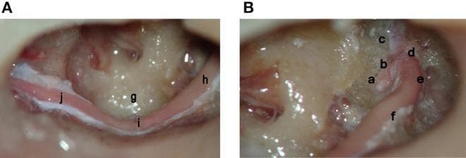 Two intraoperative endoscopic photographs (A and B) demonstrate a complete surgical decompression of the left facial nerve in a cadaveric specimen, tracing the nerve from the labyrinthine meatus to the stylomastoid foramen. Image B shows the proximal segments, including the meatal foramen (a), labyrinthine portion (b), greater superficial petrosal nerve (c), the first genu (d), the geniculate ganglion (e), and the proximal horizontal (tympanic) segment (f). Image A details the distal course, illustrating the continuation of the horizontal segment (h) as it passes the sinus tympani (g), reaching the second genu (i). From this point, the nerve transitions into its vertical (mastoid) segment (j), extending toward the stylomastoid foramen. This anatomical display highlights the relationship between the facial nerve and middle ear landmarks, such as the sinus tympani, and is relevant for otologic surgery, temporal bone fracture management, and facial nerve decompression procedures.