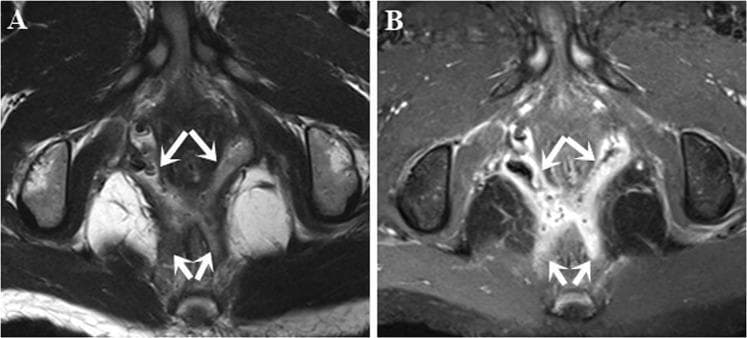 This diagnostic imaging set consists of two axial MRI slices of the pelvic region focusing on the perianal area. Image A is an axial T2-weighted turbo spin-echo (T2W TSE) sequence, and Image B is a post-contrast fat-suppressed T1-weighted turbo spin-echo (FS T1W TSE) sequence. The images demonstrate a complex high transsphincteric fistula-in-ano with associated secondary tracts. In Image A, the tracts (indicated by white arrows) appear as hyperintense (bright) linear structures against the relatively darker muscular background of the external anal sphincter and levator ani. In Image B, the secondary tracts within the ischioanal space show marked contrast enhancement, appearing significantly brighter than surrounding fat-suppressed tissues. This enhancement highlights active inflammation and the branching nature of the tracts. The visualization of these secondary extensions relative to the anal sphincter complex is critical for surgical planning and classification according to the Parks or St James's University Hospital staging systems.