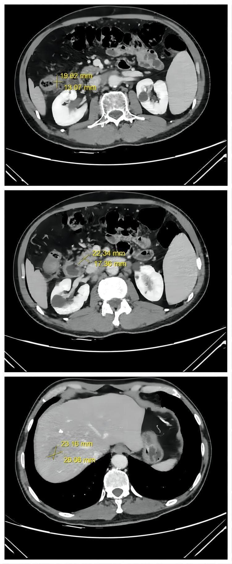 A series of three axial contrast-enhanced Computed Tomography (CT) images of the abdomen, demonstrating the therapeutic response of metastatic colorectal cancer (mCRC). The images utilize caliper measurements to quantify lesion dimensions. The top frame shows a thickened intestinal wall in the ascending colon representing the primary colon tumor. The middle frame highlights retroperitoneal lymph node metastases, characterized as a low-density soft tissue mass adjacent to the major abdominal vessels, measuring approximately 22.34 mm x 17.36 mm. The bottom frame focuses on the liver, revealing a hypo-attenuating, nodular metastasis in the right lobe with dimensions of approximately 23.16 mm x 26.06 mm. These diagnostic images track the regression of malignancy, showing a partial response (PR) following treatment. Key educational landmarks include the liver parenchyma, kidneys, vertebral body, and intestinal loops. The clinical focus is on staging and monitoring secondary malignancies, specifically liver and lymph node involvement in advanced colorectal adenocarcinoma.