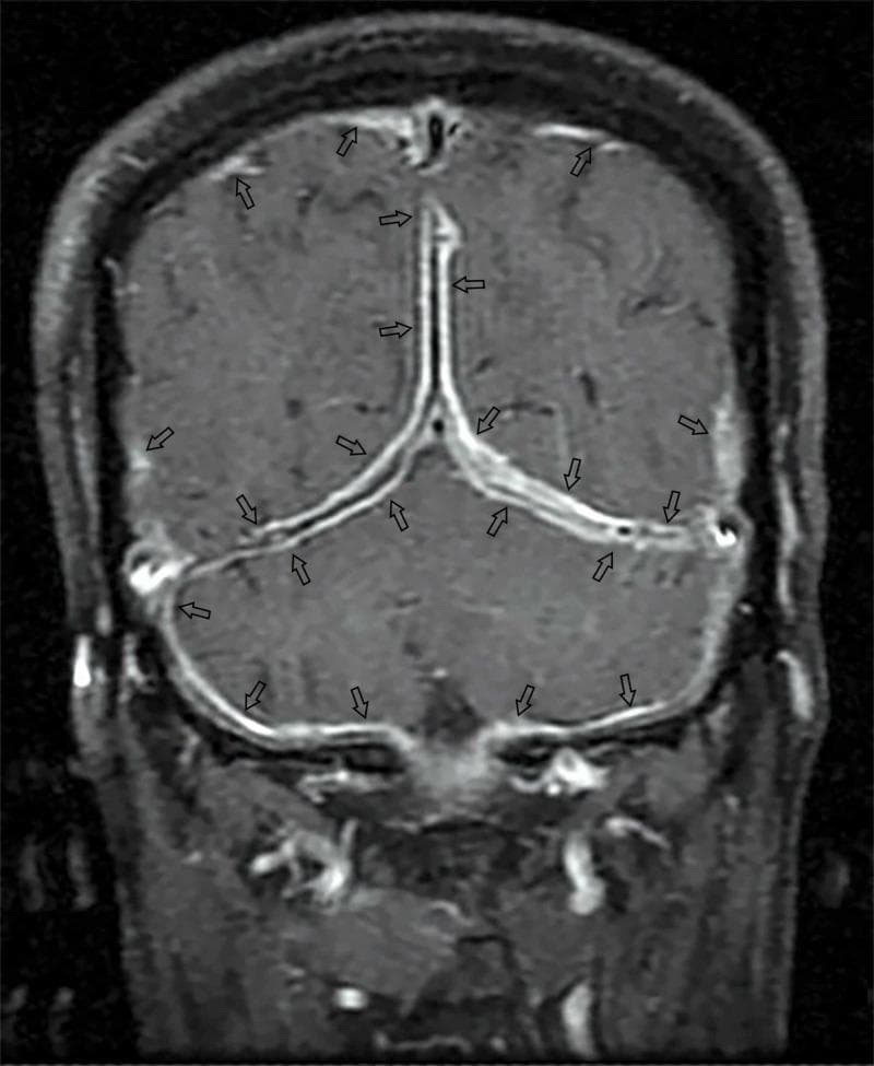 This diagnostic image is a post-gadolinium coronal T1-weighted MRI of the brain, demonstrating diffuse pachymeningeal enhancement. The visual findings show prominent, thick, linear enhancement along the dura mater, specifically involving the falx cerebri, the tentorium cerebelli, and the inner table of the skull in the posterior fossa. Multiple black arrows highlight these areas of high signal intensity, which follow the curvilinear contours of the dural folds. The enhancement is consistent with dural thickening, characteristic of conditions such as hypertrophic pachymeningitis, which in this clinical context was secondary to tuberculosis. The image serves as an educational example of how contrast-enhanced MRI identifies meningeal pathology by highlighting the uniform and diffuse distribution of contrast uptake within the dura mater rather than the deeper leptomeningeal spaces.