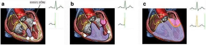 A three-part pathophysiology diagram illustrating the electrophysiological mechanism of incomplete latent preexcitation in the human heart, accompanied by representative ECG traces. Section (a) shows a cross-sectional view of the heart with a labeled accessory pathway (AP) connecting the atrium and ventricle. The normal conduction system (AV node and His-Purkinje system) is highlighted in yellow. The ECG shows a normal PR interval and QRS complex, indicating AV node conduction is faster than or equal to the AP. Section (b) illustrates the onset of ventricular preexcitation via the accessory pathway, marked by a pink-shaded activation region at the AP insertion point, while the corresponding ECG remains relatively normal. Section (c) depicts ventricular fusion where impulses from both the normal conduction system (purple) and the accessory pathway (pink) meet. This fusion results in a change to the terminal QRS vector and morphology on the ECG. The diagram serves as an educational tool for understanding Wolff-Parkinson-White (WPW) variants where preexcitation is not overt.