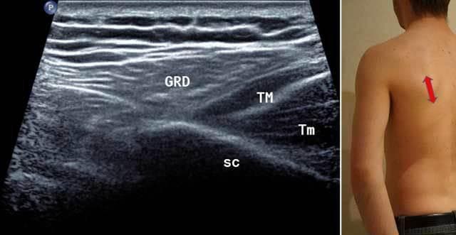 This diagnostic ultrasound image presents a sagittal medial cross-section of the posterior shoulder and upper back region, used to differentiate between superficial and deep muscular structures. The image is accompanied by a clinical photograph demonstrating the posterior probe placement (red arrow) over the lateral edge of the scapula with the arm in neutral or external rotation. Centrally, the Latissimus Dorsi (GRD) is identified as a superficial hypoechoic muscle with a layered fibrillar arrangement. Immediately superficial to the GRD, alternating bands of hypoechoic and hyperechoic tissue represent subcutaneous fat and connective tissue. Deep to the Latissimus Dorsi, the Teres Major (TM) muscle is visualized. Positioned even deeper and more inferiorly is the Teres Minor (Tm), which sits immediately adjacent to the bony surface of the Scapula (Sc). The scapula serves as the deepest landmark, appearing as a bright hyperechoic interface with posterior acoustic shadowing. This imaging approach is essential in physical medicine and musculoskeletal radiology for assessing muscle integrity, identifying myotendinous junctions, and guiding diagnostic or therapeutic injections.