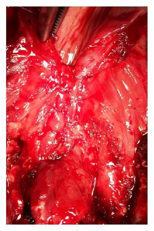Intraoperative clinical photograph showing a close-up view of the surgical field during a total laryngectomy. The image focuses on the vertical reconstruction of the neopharynx through the closure of the pharyngoesophageal segment. The visible pathology involves the exposed muscular and mucosal layers of the neck and pharyngeal region, showing expected surgical hemorrhage and tissue manipulation. A Cushing-type continuous inverting suture technique is demonstrated using a 3/0 resorbable polyglactin 910 suture, creating a tight, linear seal. A surgical instrument, likely a hemostatic clamp or forceps, is partially visible at the superior margin of the field. This image serves as a clinical illustration of head and neck surgical techniques, specifically pharyngeal closure methods following radical laryngeal resection.