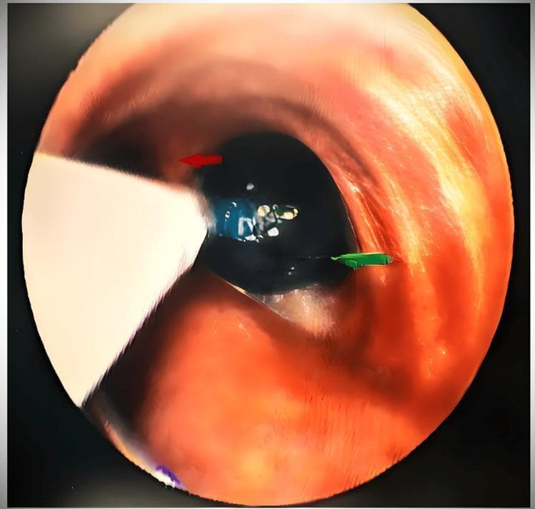 This clinical diagnostic image shows a bronchoscopic view of the tracheobronchial tree during the placement of an EZ bronchial blocker. The visual focuses on the carina (indicated by a red arrow), which serves as the primary anatomical landmark for positioning. A Y-shaped bronchial blocker is seen 'stranded' or seated directly on the carina, with its distal bifurcations extending into the left and right mainstem bronchi. Within the right bronchus, a green arrow points to a distended, inflated blue cuff that occupies the lumen. This configuration is used in thoracic anesthesia to achieve one-lung ventilation (OLV) by mechanically occluding a specific bronchus. The image demonstrates the correct endoscopic verification of device placement, ensuring the blocker is securely anchored at the carina to prevent intraoperative dislodgement and to facilitate isolated lung collapse for surgical procedures such as bronchogenic cyst excision.