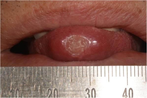 This clinical photograph displays a close-up intraoral view of a focal pathology on the human tongue. A solitary, well-circumscribed, round ulcer is centrally located on the tip of the tongue (apex linguae). The lesion measures approximately 0.7 cm in diameter as indicated by the adjacent surgical ruler. Morphologically, the ulcer features a slightly elevated, whitish, indurated-appearing border and a depressed, granular, pale-yellowish base. The surrounding lingual mucosa appears erythematous and mildly edematous, with the lateral margins of the tongue showing slight impressions from the teeth. This image illustrates a chronic oral ulcer, which in a clinical context represents a differential diagnosis including major aphthous stomatitis, traumatic granuloma, squamous cell carcinoma, or granulomatous infections such as oral tuberculosis. It is a key educational resource for oral pathology, dermatology, and infectious disease training, emphasizing the importance of biopsy for persistent, firm oral lesions.