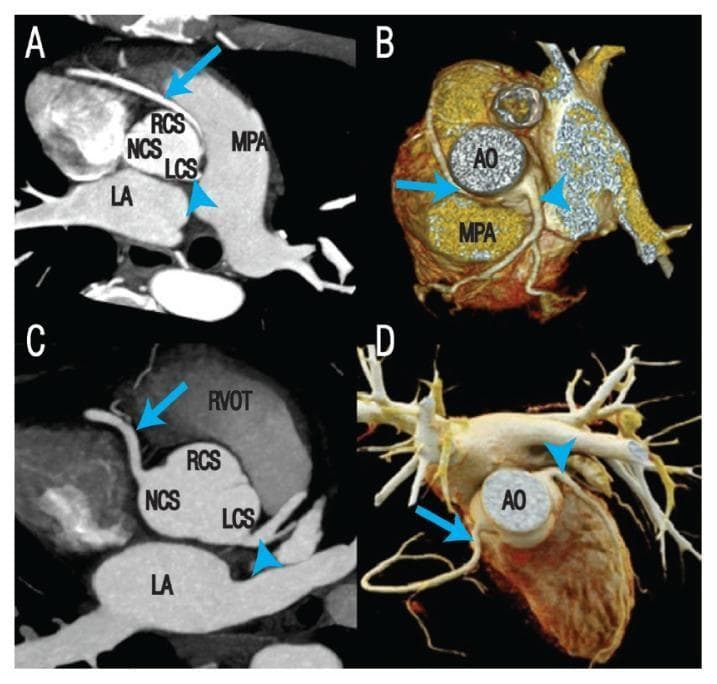 This diagnostic image composite features axial maximal intensity projection (MIP) coronary CT angiography (A, C) and 3D volume-rendered reconstructions (B, D) illustrating Anomalous Origin of the Coronary Artery from the Opposite Sinus (ACAOS). Panels A and B demonstrate an anomalous Right Coronary Artery (RCA, arrow) arising from the Left Coronary Sinus (LCS). The RCA follows a high-risk interarterial course, passing between the Aorta (AO) and the Main Pulmonary Artery (MPA). Panels C and D show a variant where the RCA (arrow) originates from the Non-Coronary Sinus (NCS), passing near the Right Ventricular Outflow Tract (RVOT). Key anatomical landmarks labeled include the Left Atrium (LA), Right Coronary Sinus (RCS), and the aortic root. This visual material is used in cardiovascular radiology to teach the identification of coronary anomalies and to assess the spatial relationship between anomalous vessels and great arteries, which is critical for determining the risk of sudden cardiac death and planning surgical interventions like coronary deroofing.