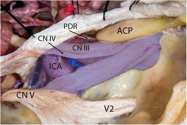 This clinical photograph displays a high-magnification cadaveric dissection of the human middle cranial fossa, specifically focused on the neurovascular anatomy of the cavernous sinus region. The image utilizes a blue color overlay to represent the boundaries of the cavernous sinus venous space. Key anatomical structures labeled include the internal carotid artery (ICA), the anterior clinoid process (ACP), and the proximal dural ring (PDR). The spatial relationships of several cranial nerves (CN) are demonstrated: the oculomotor nerve (CN III) and trochlear nerve (CN IV) are seen coursing superiorly and anteriorly to the ICA. The trigeminal nerve (CN V) and its second division, the maxillary nerve (V2), are situated inferiorly. Notably, the V2 is shown passing outside the demarcated blue venous space of the cavernous sinus, illustrating its anatomical position relative to the dural envelop. This educational visual is intended for neurosurgical training and advanced anatomical study of the skull base, highlighting the complex arrangement of structures relevant to transsphenoidal or cavernous sinus surgical approaches.