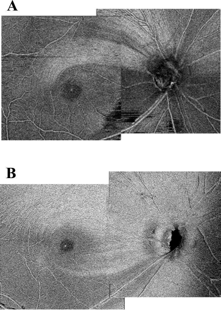 Diagnostic en-face optical coherence tomography (OCT) images of the human retina, illustrating two distinct patterns of Retinal Nerve Fiber Layer (RNFL) degradation associated with glaucoma or optic neuropathy. Panel A demonstrates localized, severe damage to the papillomacular bundle, characterized by a significant loss of nerve fiber density and disrupted texture between the optic disc and the macula. Only sparse, residual nerve fibers are visible in this critical functional zone. Panel B displays a diffuse RNFL defect, where thinning is widespread across the posterior pole rather than confined to a specific bundle. The overall texture in Panel B appears paler and more uniform due to global fiber attrition, with a marked reduction in the characteristic striations of a healthy RNFL. These images serve as an educational comparison for identifying different morphological presentations of nerve fiber loss, which correlates with visual field deficits observed in Humphrey Field Analyzer (HFA) 10-2 examinations.