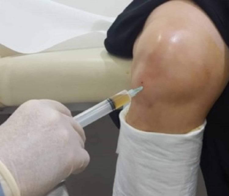 A clinical procedural photograph demonstrating an intra-articular injection of Platelet-Rich Plasma (PRP) into a patient's knee joint. A gloved hand is shown administering approximately 5cc of a translucent, straw-colored fluid via a syringe. The needle entry point is localized to the lateral aspect of the knee, positioned approximately 1 cm lateral to the patellar tendon and 1 cm inferior to the joint line. The anatomical landmarks of the patella and joint space are visible under the skin. The patient's lower leg is partially covered by a white protective cast or drape, and the procedure is being performed in a clinical setting on a treatment table. This image illustrates the standard clinical technique for regenerative therapy in the management of knee osteoarthritis.