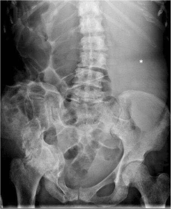 This abdominal radiograph (X-ray) illustrates the classical imaging triad of primary myelofibrosis. The axial and appendicular skeleton, including the lumbar vertebrae, pelvic bones, and proximal femurs, demonstrate diffuse, symmetric osteosclerosis, evidenced by an overall increased radiographic density (whiter appearance) and loss of normal trabecular clarity. In the soft tissues, a massive, homogeneous soft tissue opacity is visible in the left upper quadrant (marked with an asterisk), representing severe splenomegaly. This enlarged splenic mass exerts significant mass effect, resulting in the marked displacement of gas-filled small and large bowel loops toward the right side of the abdomen. These findings reflect the systemic bone marrow remodeling and extramedullary hematopoiesis characteristic of myeloproliferative neoplasms. The image serves as a key diagnostic example of how hematological disorders can manifest through both skeletal density changes and profound organomegaly on plain film imaging.