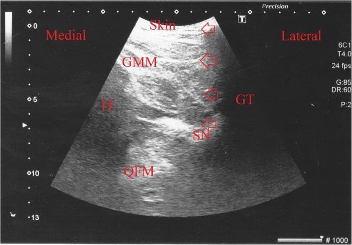 This diagnostic ultrasound image demonstrates the posterior subgluteal approach for a sciatic nerve block in a transverse (short-axis) view. The image illustrates key anatomical landmarks including the Gluteus Maximus Muscle (GMM) superficial to the deep structures, the Greater Trochanter (GT) laterally, and the Ischial Tuberosity (IT) medially. Deep to the GMM and between the GT and IT lies the Quadratus Femoris Muscle (QFM). The Sciatic Nerve (SN) is identified as a hyperechoic oval structure situated in the fascial plane between the GMM and QFM. Red arrows track the needle trajectory from the lateral-superior aspect toward the target nerve, while white triangles highlight the needle tip. A hypoechoic area labeled 'LA' indicates the distribution of local anesthetic surrounding the nerve. This visual serves as a procedural guide for regional anesthesia, highlighting the importance of real-time ultrasound guidance to ensure precise needle placement and adequate spread of anesthetic while avoiding vascular or bony structures.