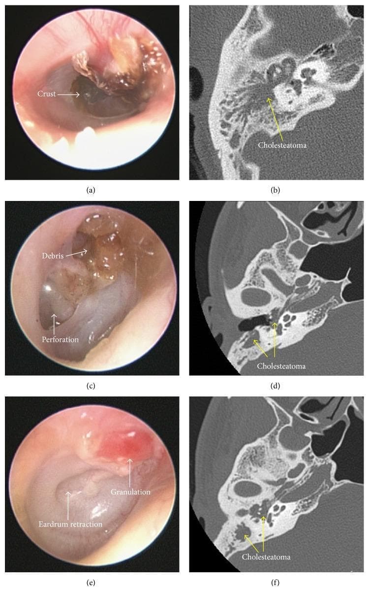 A six-panel clinical and diagnostic comparison illustrating the diagnostic challenges of identifying acquired cholesteatoma. The left column (a, c, e) contains otoscopic images showing common physical barriers to examination: (a) dark crusting along the superior canal wall, (c) brownish amorphous debris associated with a visible tympanic membrane perforation, and (e) erythematous granulation tissue with significant eardrum retraction. These external and middle ear findings often mask deeper pathology. The right column (b, d, f) provides corresponding high-resolution computed tomography (HRCT) axial scans of the temporal bone. The HRCT images clearly reveal soft-tissue opacification within the middle ear cleft, attic, and mastoid antrum, labeled as 'Cholesteatoma'. These diagnostic images demonstrate bony erosion and characteristic expansive growth that remained hidden or partially obscured during clinical otoscopy. This comparison emphasizes the clinical necessity of thorough canal debridement and the utility of HRCT in identifying cholesteatomas that are sequestered by superficial inflammatory changes, crust, or anatomical retractions.