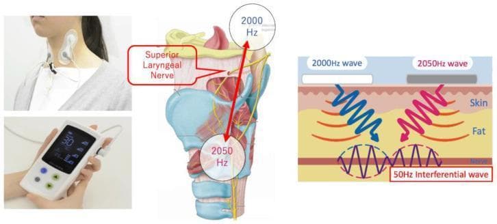 This composite educational image illustrates the application and mechanism of Transcutaneous Electrical Sensory Stimulation (TESS) for swallowing rehabilitation. The first panel shows a clinical photograph of surface electrodes positioned on the lateral cervical region of a patient. The central panel is an anatomical diagram of the larynx and pharynx, highlighting the superior laryngeal nerve. It demonstrates the placement of two frequencies—2000 Hz superiorly and 2050 Hz inferiorly—targeting the laryngeal structures. The final panel is a pathophysiology diagram explaining the interferential current (IFC) principle: two medium-frequency sine waves (2000 Hz and 2050 Hz) penetrate the skin and fat layers to intersect at the deeper nerve layer. This intersection creates a 50 Hz interferential wave, providing targeted stimulation to deep-seated nerves while minimizing superficial skin irritation. This technology is used for muscle atrophy amelioration and sensory stimulation in dysphagia management. The image also displays the 'Gentle-Stim' handheld control device.