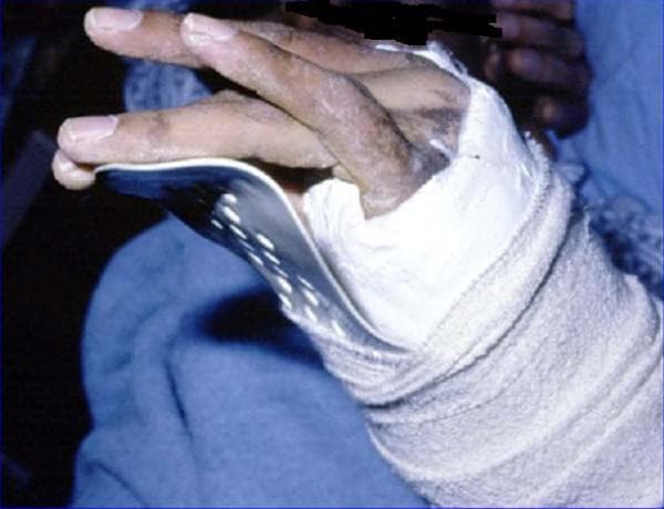 This clinical photograph shows the forearm and hand of a 25-year-old patient who sustained a radial neck fracture resulting in 'wrist drop' due to radial nerve palsy. The forearm is immobilized in a bulky white plaster-of-Paris cast and compression bandaging. A volar cock-up splint, constructed from metallic or rigid synthetic material with visible circular perforations for ventilation, extends from the palm to support the fingers and stabilize the wrist in a functional neutral or slightly extended position. This orthotic intervention is critical to prevent contractures and manage the motor deficit associated with radial nerve injury. The skin of the visible fingers appears dry with evidence of minor ecchymosis or post-traumatic discoloration on the dorsal aspect of the hand. The image serves as an educational example of traumatology management, specifically the conservative or post-surgical immobilization of peripheral nerve injuries following proximal radius fractures.