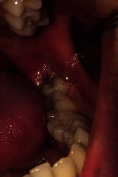 This intraoral clinical photograph displays a vertically semi-impacted mandibular third molar. The primary finding is acute pericoronitis, characterized by significant erythema and localized inflammatory swelling of the operculum and surrounding gingival tissues. The soft tissue distal to the second molar is notably edematous with a glistening surface, suggesting the presence of inflammatory exudate or pus within the follicular space. The third molar is partially erupted, with a large portion of its occlusal surface still obscured by the inflamed gingival flap. Dark staining or debris is visible on the exposed crown surface, adjacent to the distal aspect of the second molar. This image serves as a clinical example of localized periodontal inflammation associated with impacted dentition, a common indication for surgical extraction in oral and maxillofacial surgery.