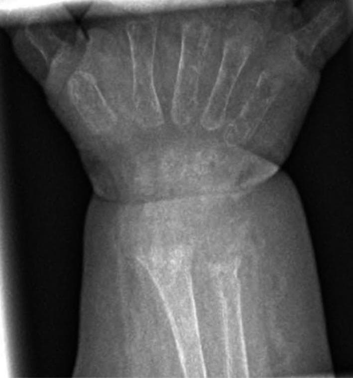 This diagnostic image is an anteroposterior (AP) x-ray radiograph of a pediatric wrist and hand. The imaging demonstrates hallmark signs of rickets, most notably at the distal radius and ulna. Key radiographic findings include generalized osteopenia, characterized by reduced bone mineral density, and significant metaphyseal irregularities. Specifically, the metaphyses of the radius and ulna show prominent 'cupping' (a concave deformity of the distal ends) and 'fraying' (a ragged, brush-like appearance of the mineralizing margin). The physis (growth plate) appears widened, and the demarcation between the metaphysis and the carpal region is ill-defined. These features are classic manifestations of impaired bone mineralization typical of nutritional or hypophosphatemic rickets. The image serves as an educational example of metabolic bone disease in pediatric patients, illustrating the structural alterations that occur in rapidly growing long bones during states of vitamin D deficiency or mineral imbalance.